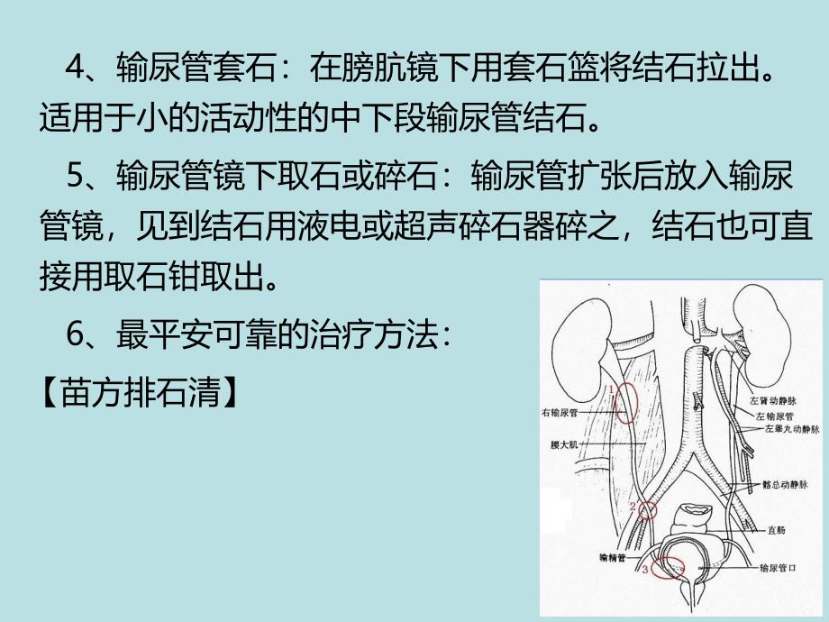 输尿管结石怎么治疗_第3页