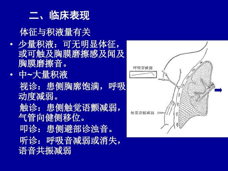 第七节胸腔积液_第5页