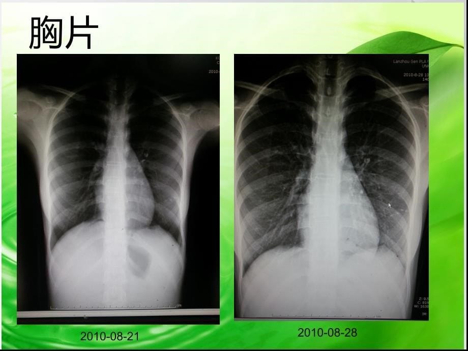 感染性心内膜炎致急性心肌梗死课件_第5页