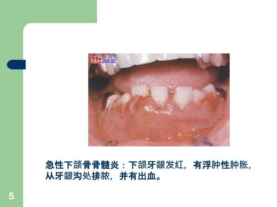 口组病颌骨疾病_第5页