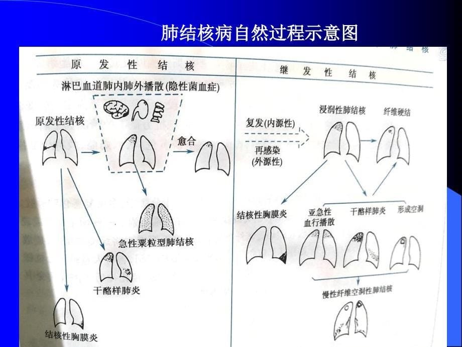 肺结核诊断和治疗指南解读_第5页