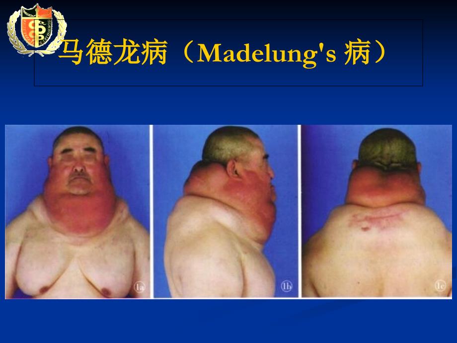 马德龙病基础知识Madelungsdisease_第1页