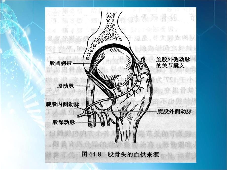 股骨头缺血性坏死ppt课件.ppt_第4页