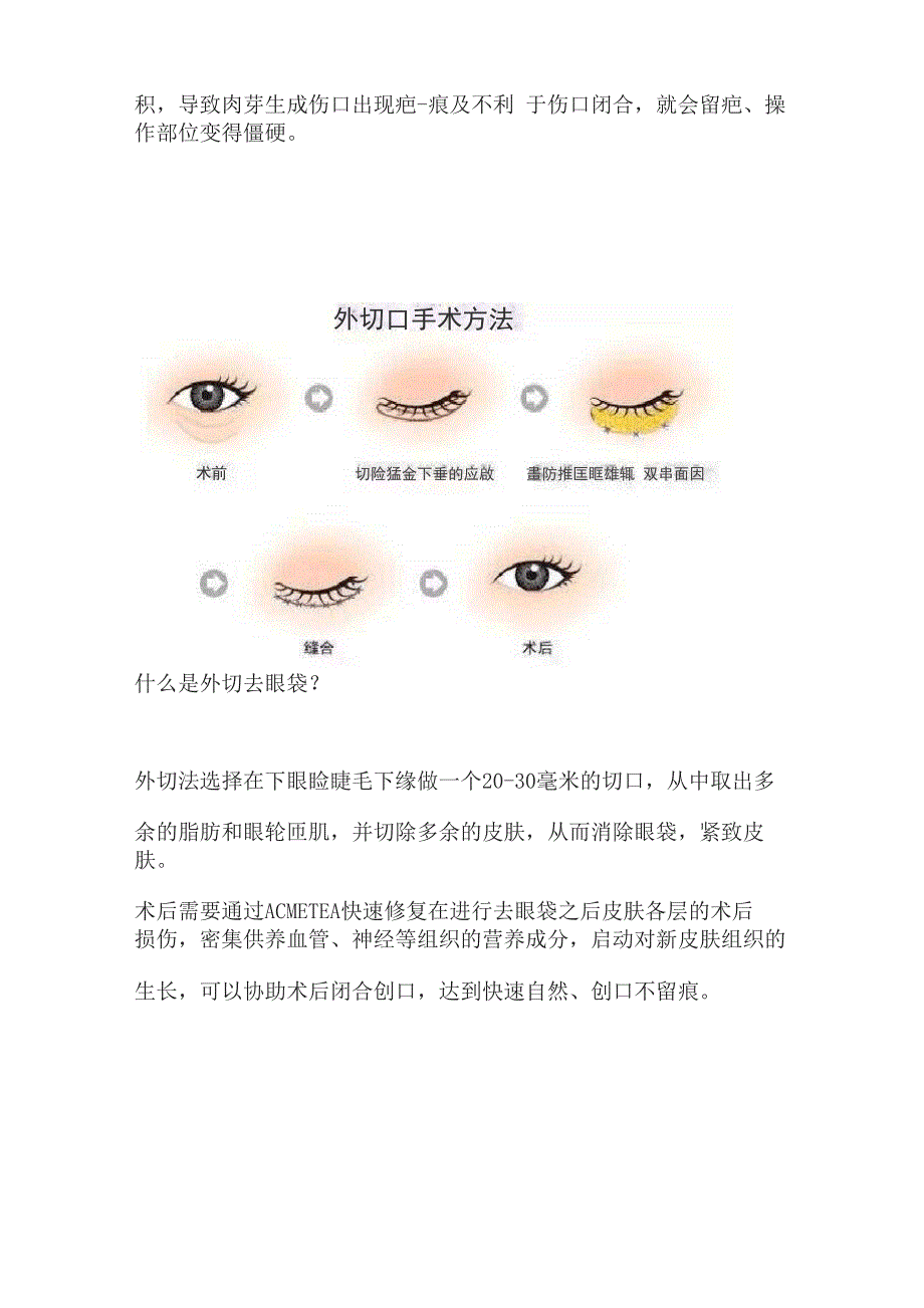 手术去眼袋后会复发吗外切去眼袋手术后一般可以保持5_第2页