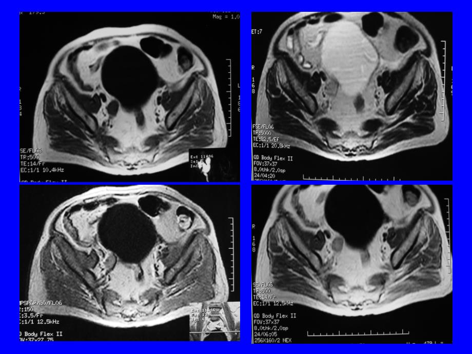 盆腔及肛周疾病mri诊断ppt课件_第4页