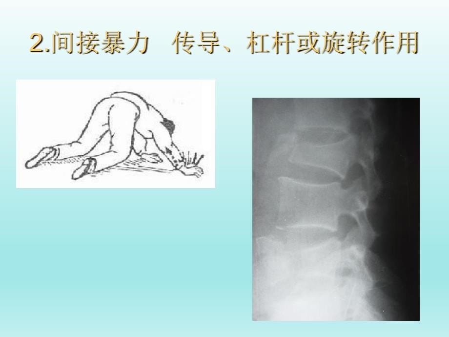 《骨折概论》课件2_第5页