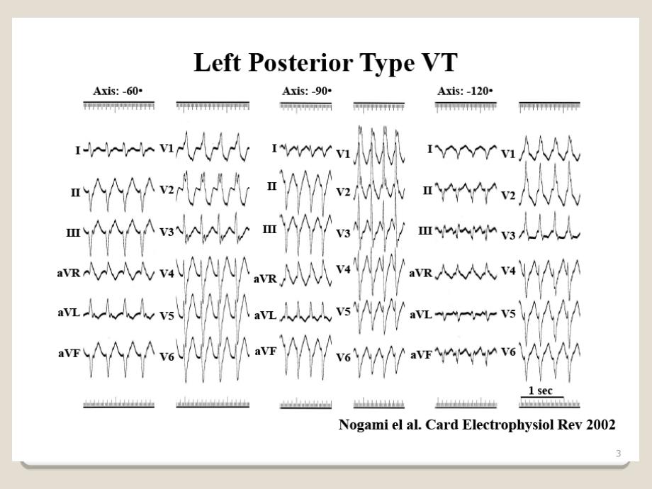 左后分支型室速ppt课件_第3页