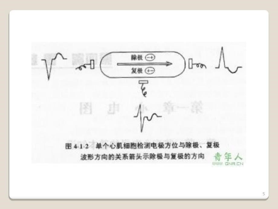 左后分支型室速ppt课件_第5页