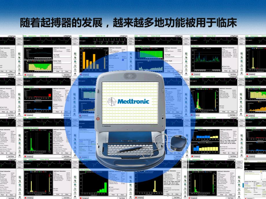 起搏器特殊功能及临床表现.ppt_第3页