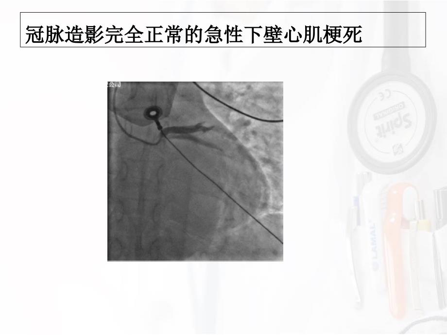 冠心病搭桥手术_第4页