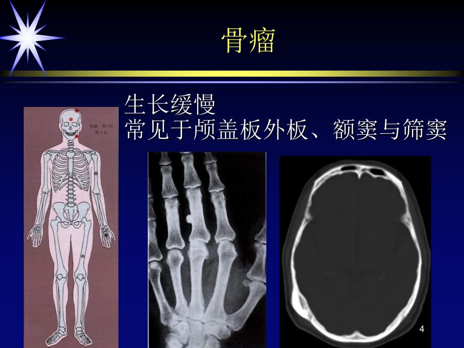 良性骨肿瘤与肿瘤样病变ppt课件_第4页