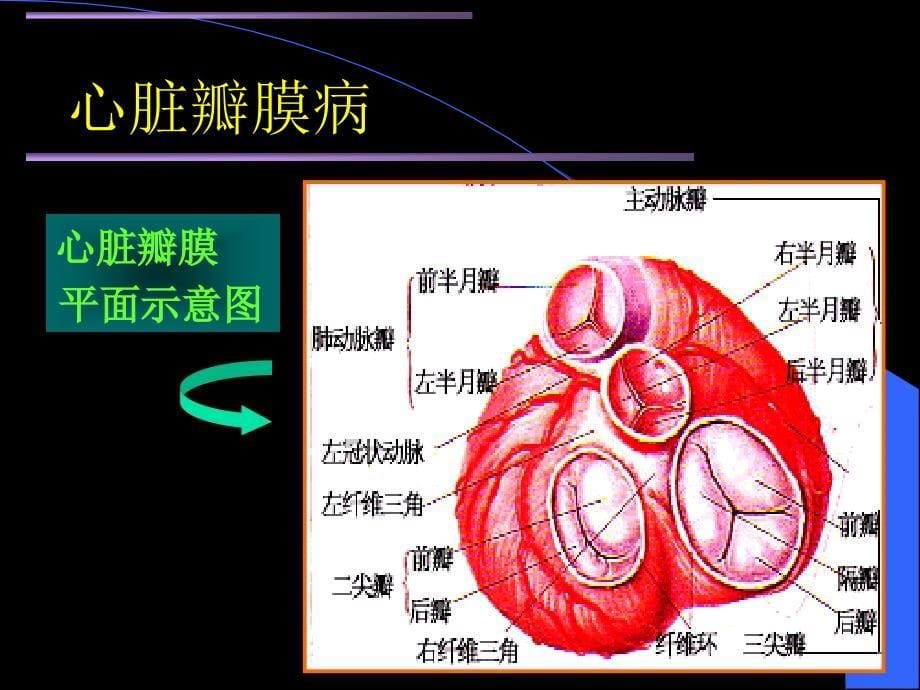 心脏瓣膜病 感染性心内膜炎_第5页