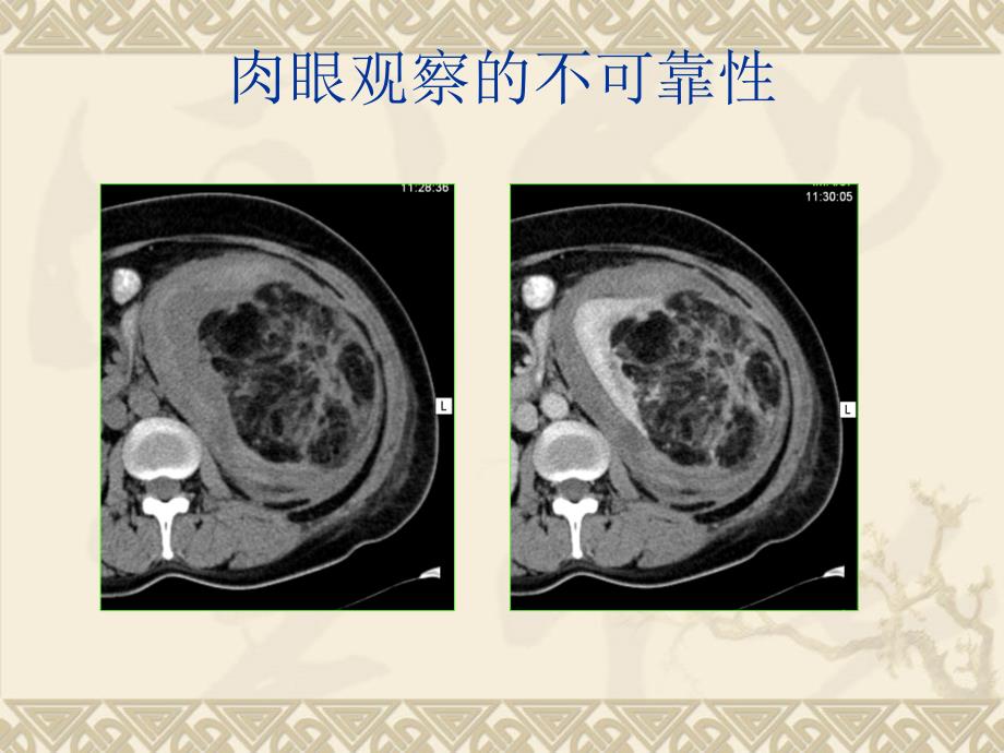 泌尿系统ct检查的要领下_第4页