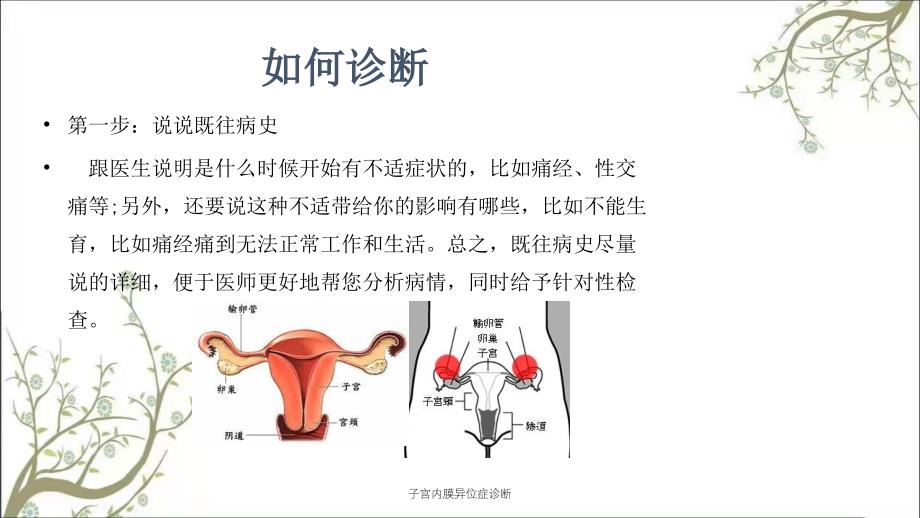 子宫内膜异位症诊断_第3页