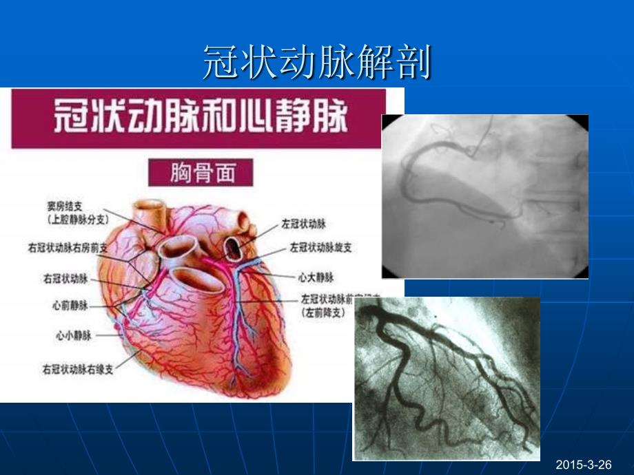 急性心肌梗死的心电图演变_第4页