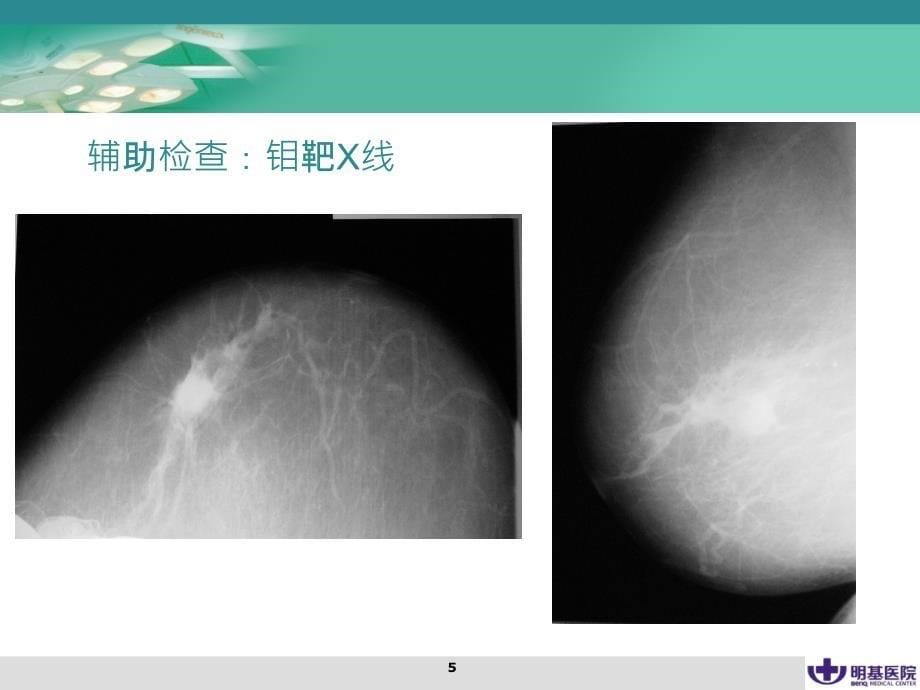 乳腺癌教学查房PPT参考幻灯片_第5页