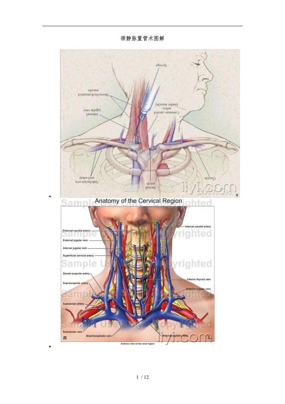 颈内静脉置管术图解_第1页