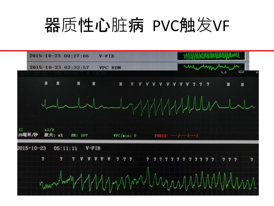 室性心律失常射频消融优质PPT课件_第4页