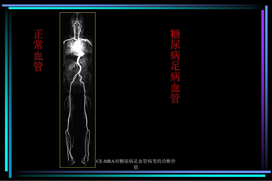 CEMRA对糖尿病足血管病变的诊断价值课件_第2页