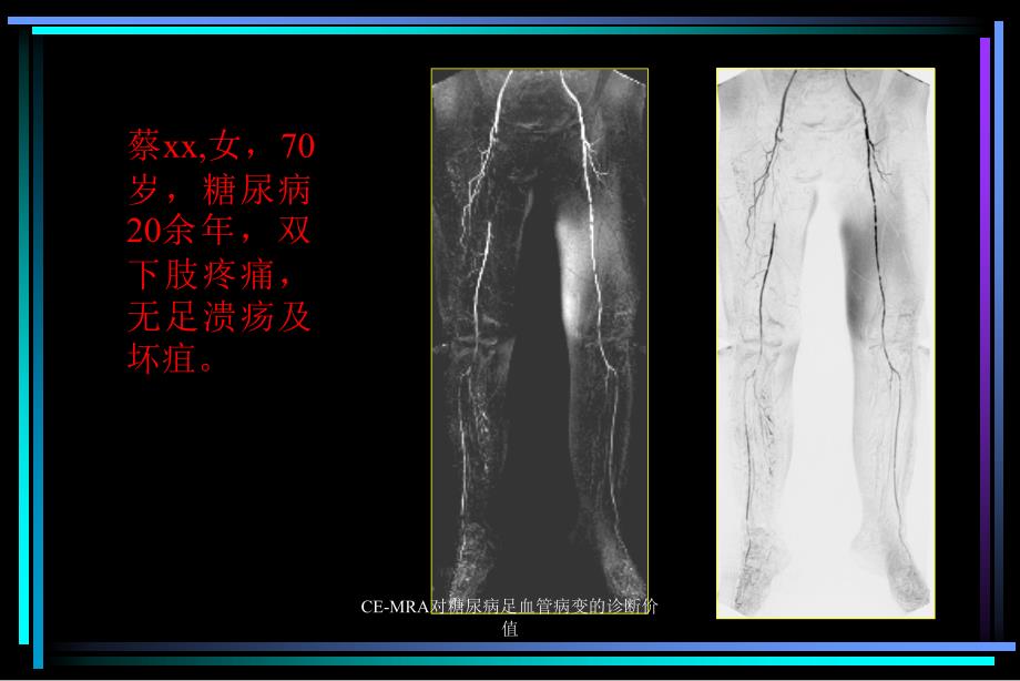 CEMRA对糖尿病足血管病变的诊断价值课件_第3页