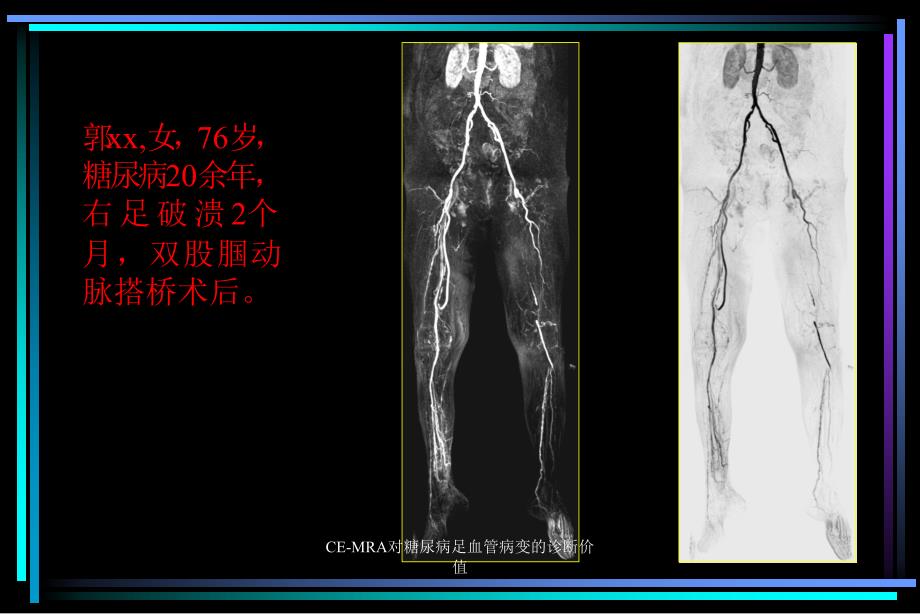 CEMRA对糖尿病足血管病变的诊断价值课件_第4页