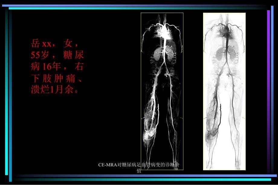 CEMRA对糖尿病足血管病变的诊断价值课件_第5页