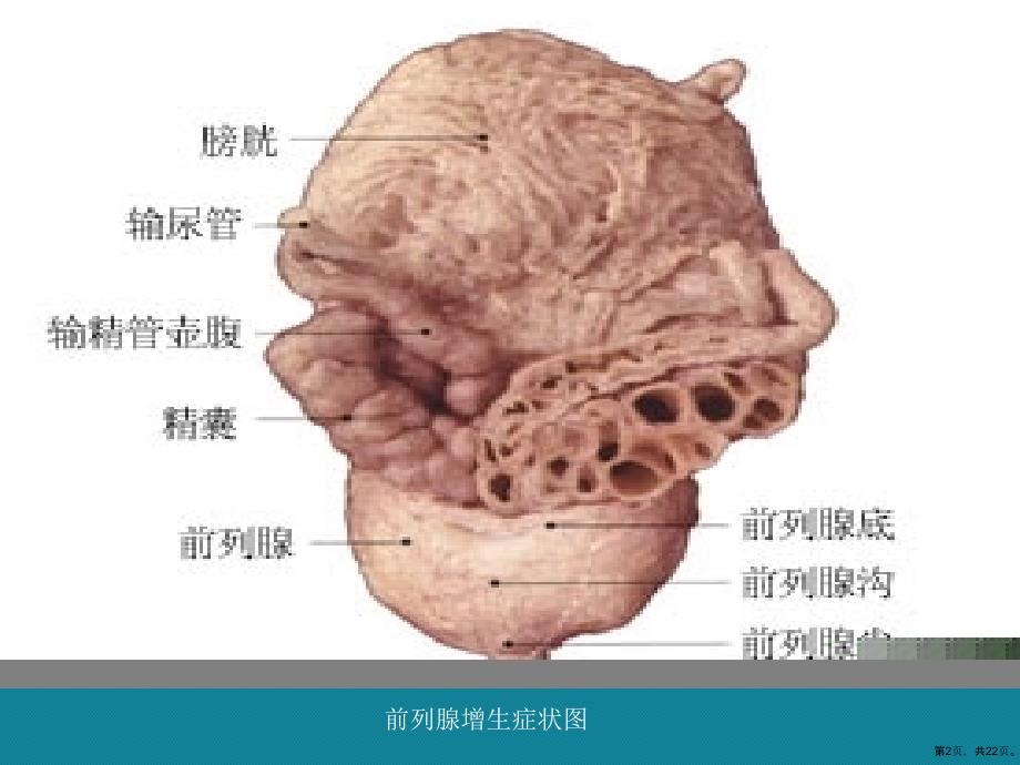 (优选)经尿道前列腺电切术后的护理课件_第2页