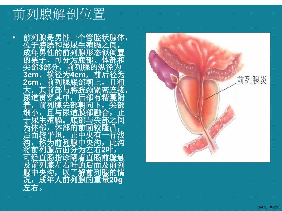 (优选)经尿道前列腺电切术后的护理课件_第4页