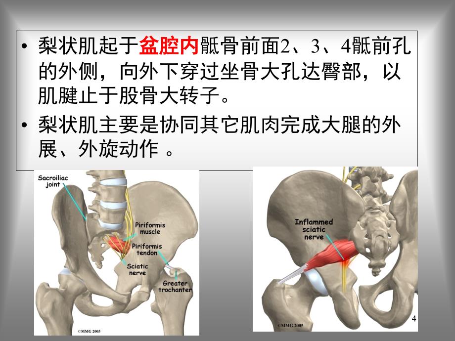 梨状肌综合征.PPT_第4页