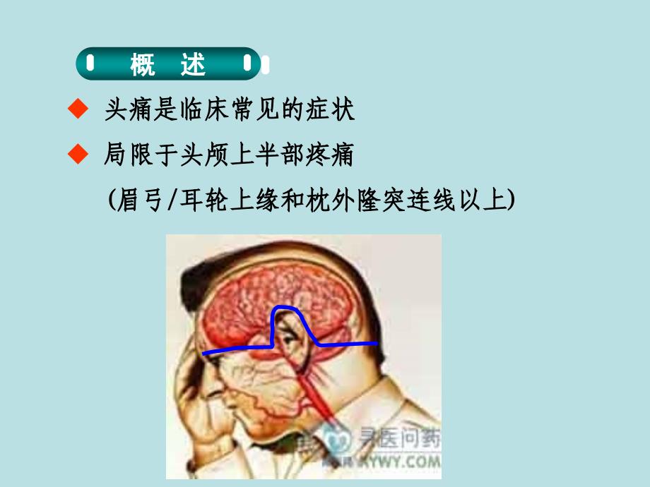 常见头痛类型及其诊断标准讲义_第3页