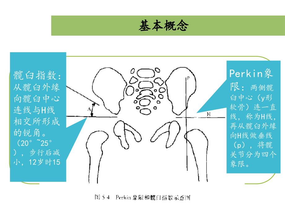 发育性髋关节脱位ppt课件_第4页