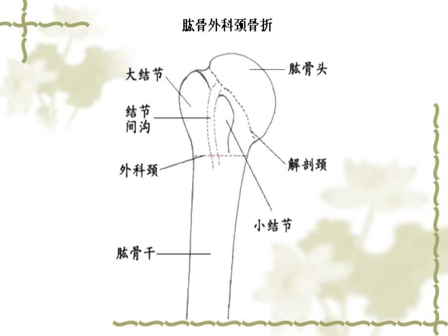 股骨外科颈骨折演示课件_第4页