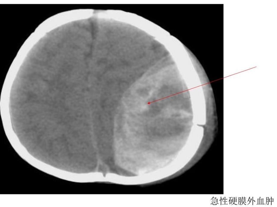 《脑外伤典型病例》PPT课件.ppt_第2页