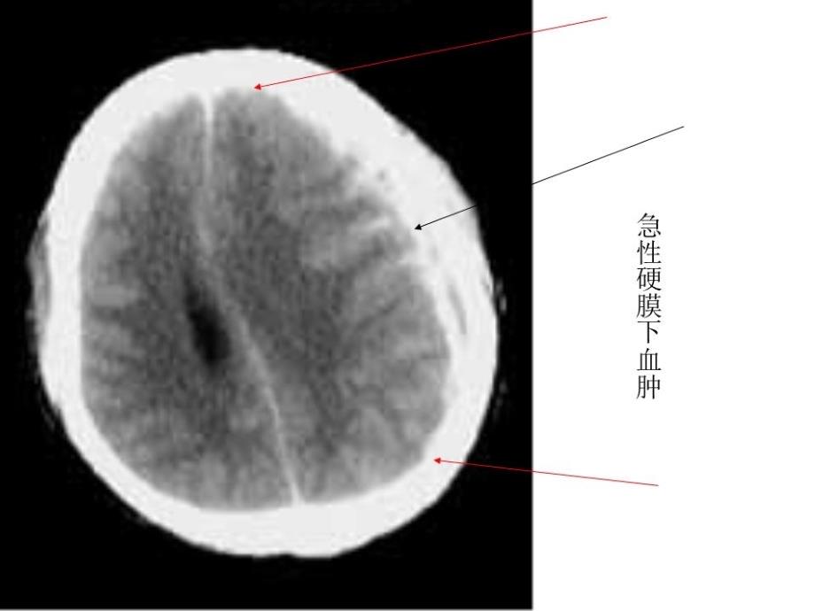 《脑外伤典型病例》PPT课件.ppt_第4页