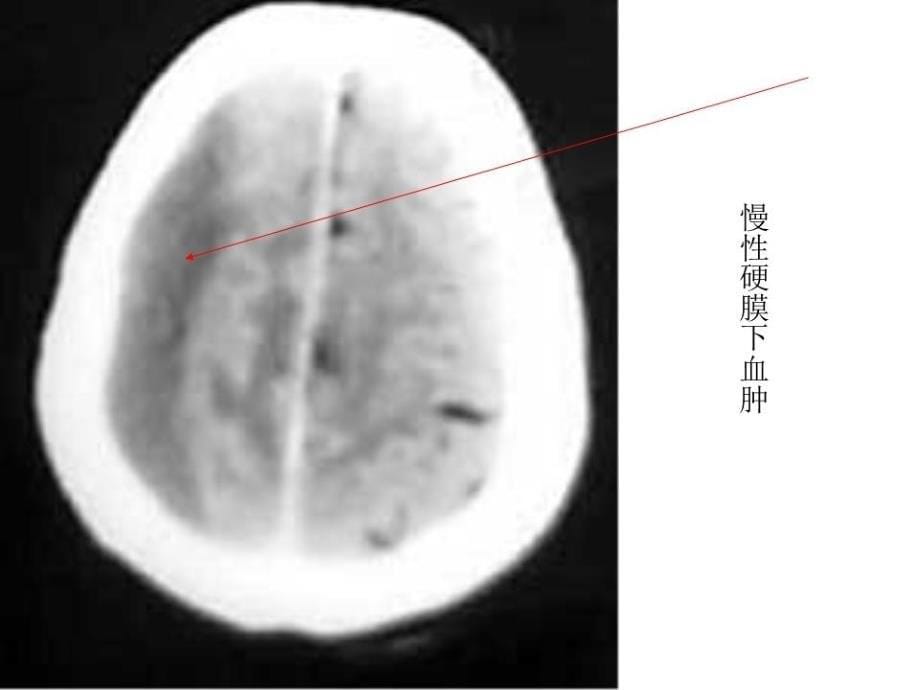 《脑外伤典型病例》PPT课件.ppt_第5页