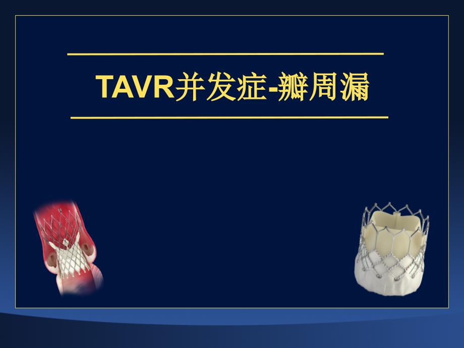 医学专题：TAVR并发症-瓣周漏_第1页