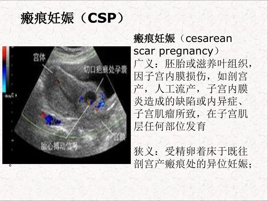 医学专题：子宫瘢痕妊娠.._第2页