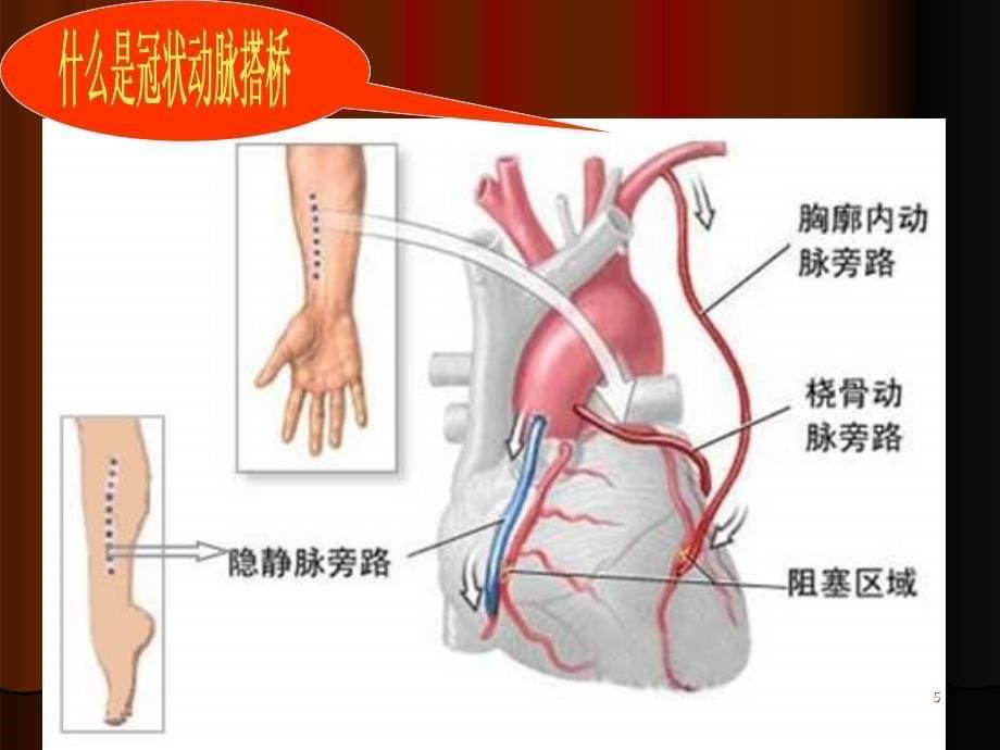 冠状动脉搭桥术后监护PPT课件_第5页