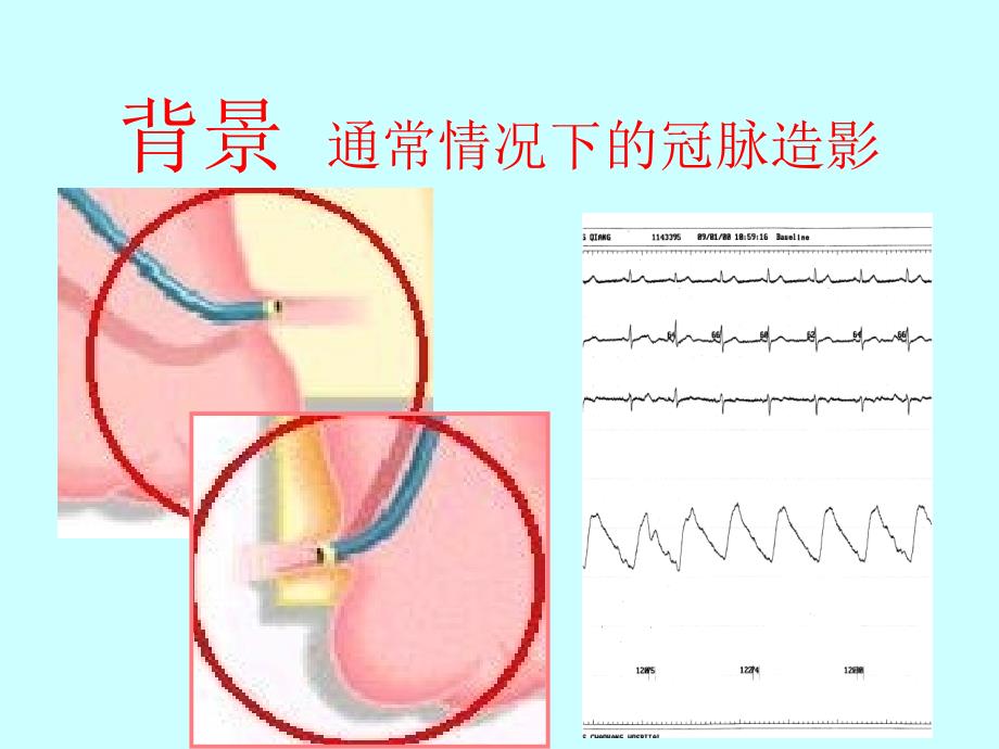 冠状动脉开口处病变选择性冠状动脉造影的方法学改良_第4页