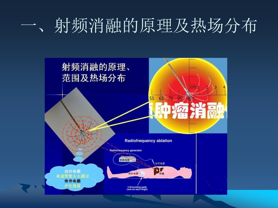 射频消融术的重大技术突破一AgreatbreakthroughonRFA_第2页