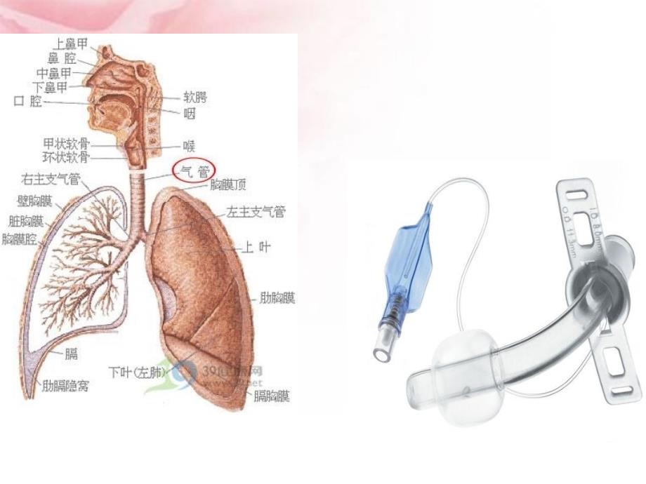 气管切开术后护理_第3页