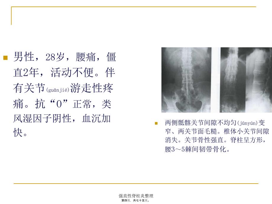 强直性脊柱炎整理课件_第4页