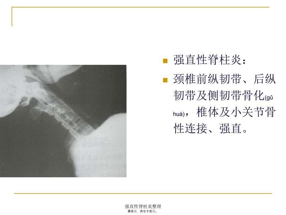 强直性脊柱炎整理课件_第5页