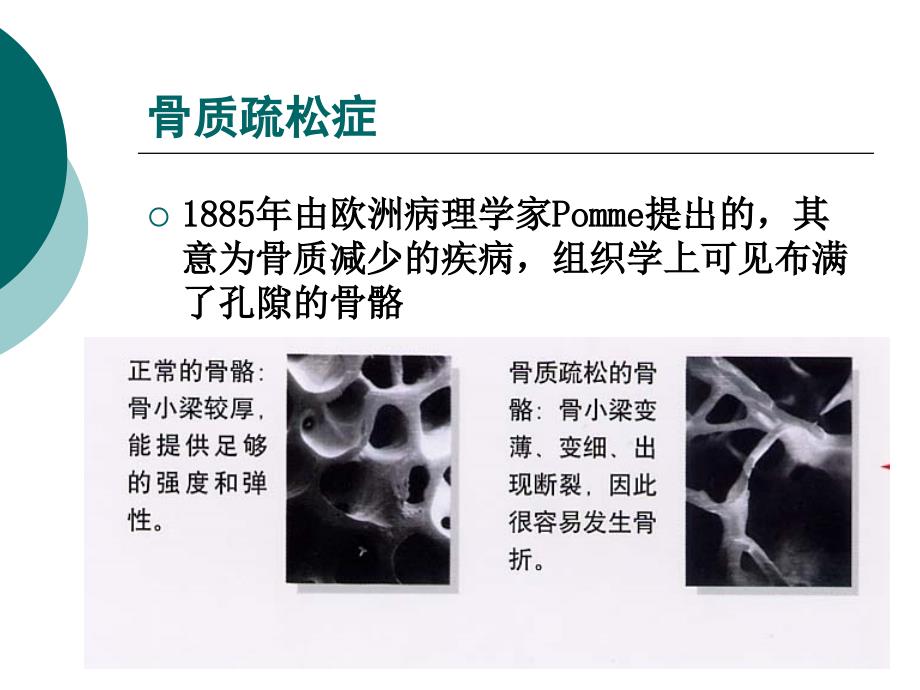 骨密度检查PP课件_第3页