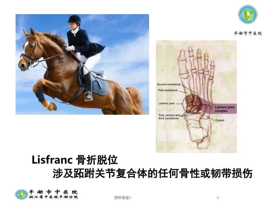 Lisfranc损伤的诊断与治疗策略行业荟萃_第4页