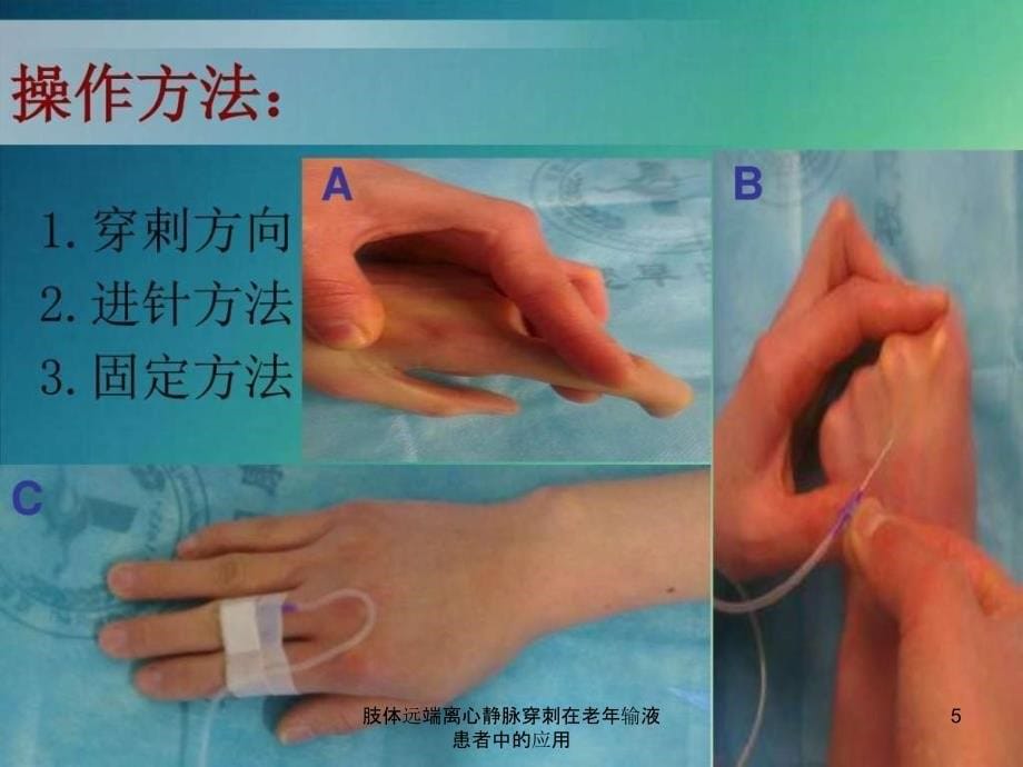 肢体远端离心静脉穿刺在老年输液患者中的应用课件_第5页