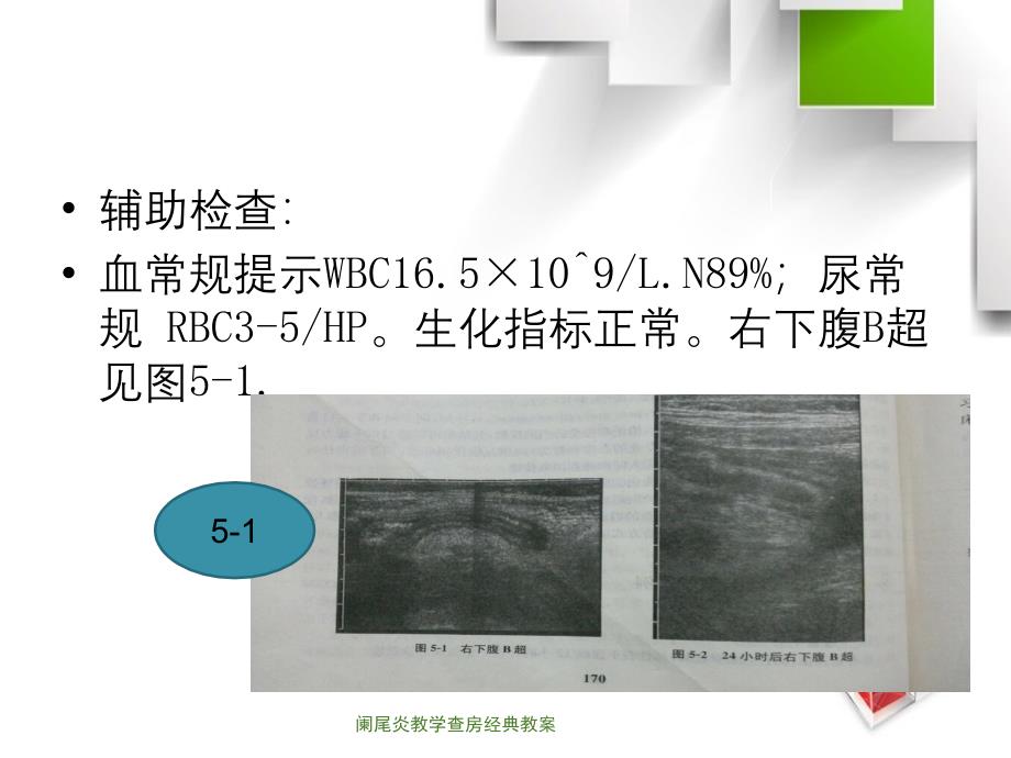 阑尾炎教学查房经典教案课件_第4页