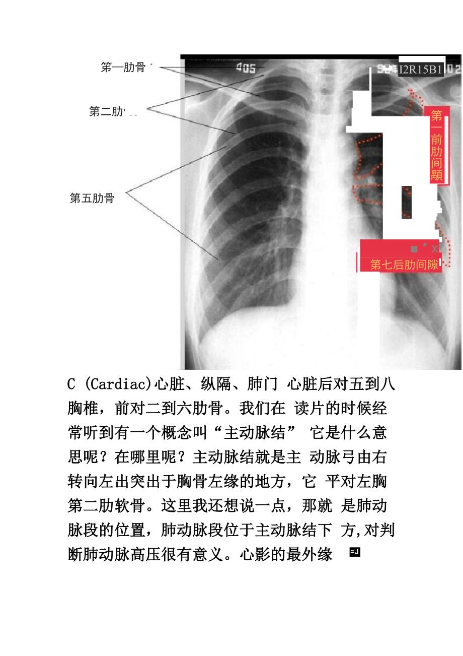 阅读胸片顺序ABCDE_第3页