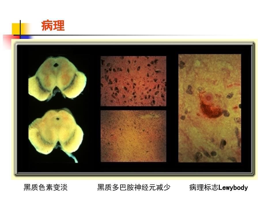 《帕金森病及其康复》PPT课件培训讲学_第5页