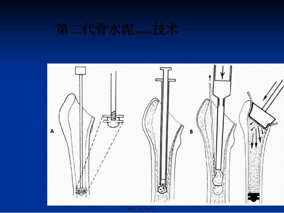 医学专题—人工髋置换的骨水泥技术21818_第5页